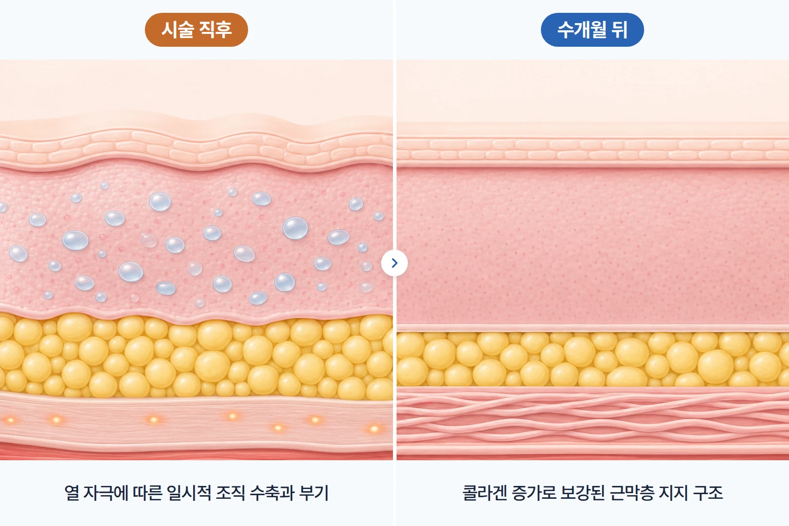 시술 직후 부기로 팽팽해진 피부층과 수개월 뒤 콜라겐이 보강된 근막층 지지 구조를 비교한 단면도