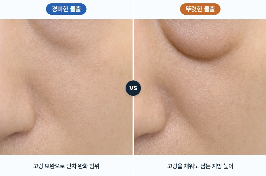 경미한 눈밑 지방 돌출과 뚜렷한 지방 돌출에 따른 눈물고랑 높이 차이 및 필러 적용 한계를 비교한 이미지