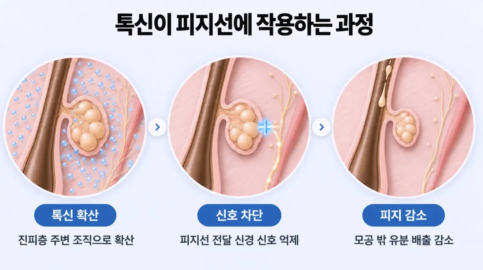 톡신이 피부 진피층에 퍼져 피지선으로 가는 신경 신호를 차단하고 유분 배출을 줄이는 3단계 작용 과정 모식도