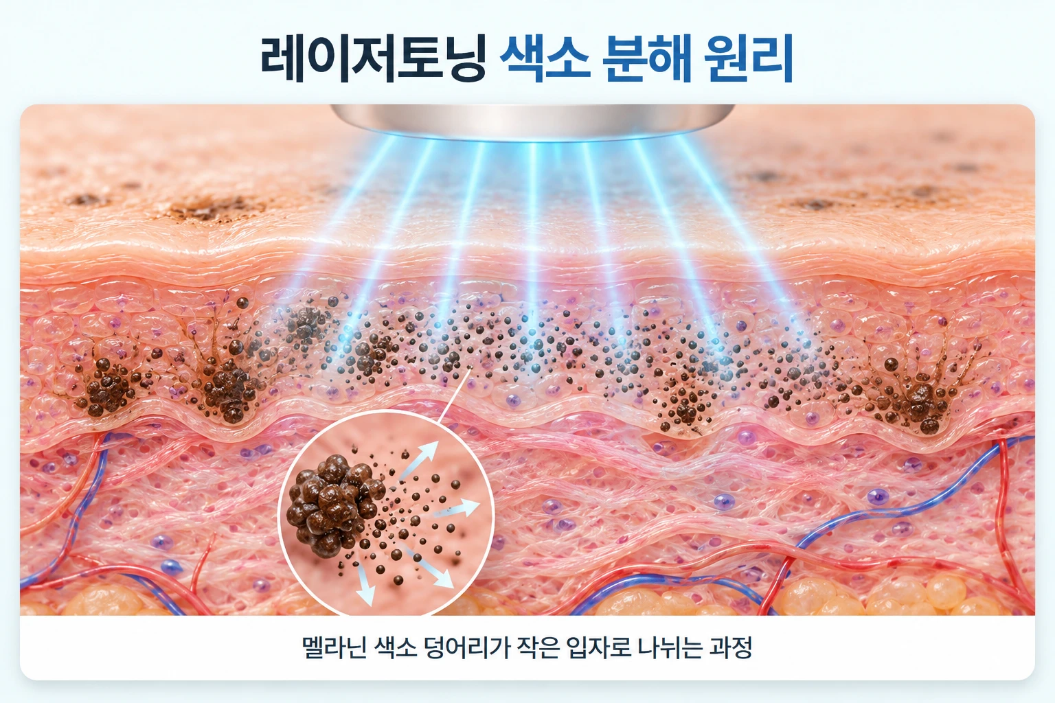 저출력 레이저 빛이 표피 속 멜라닌 색소 덩어리에 닿아 작은 입자로 나뉘는 원리를 나타낸 개념도