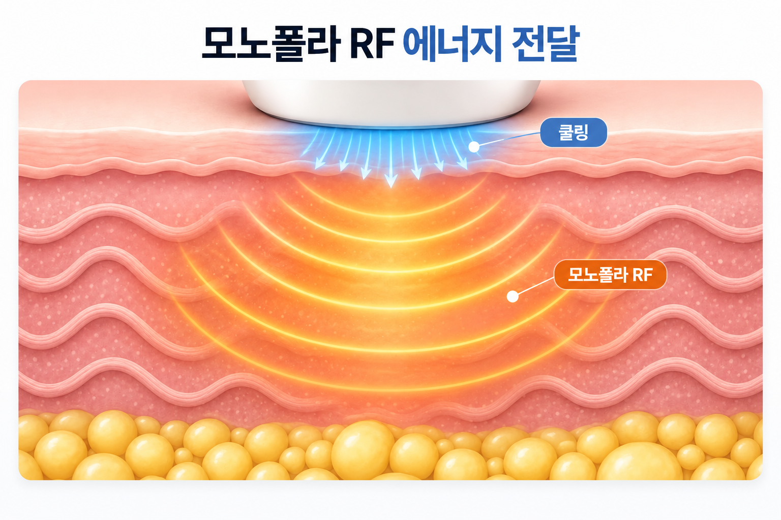 볼뉴머 모노폴라 RF 열 에너지와 표면 쿨링의 피부 전달 구조