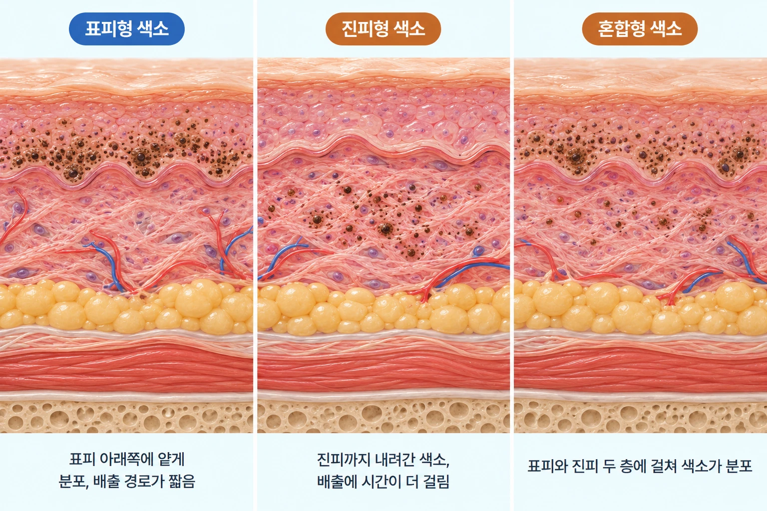 표피형, 진피형, 혼합형 기미 색소가 자리한 깊이를 동일 배율로 비교한 피부 단면 모식도