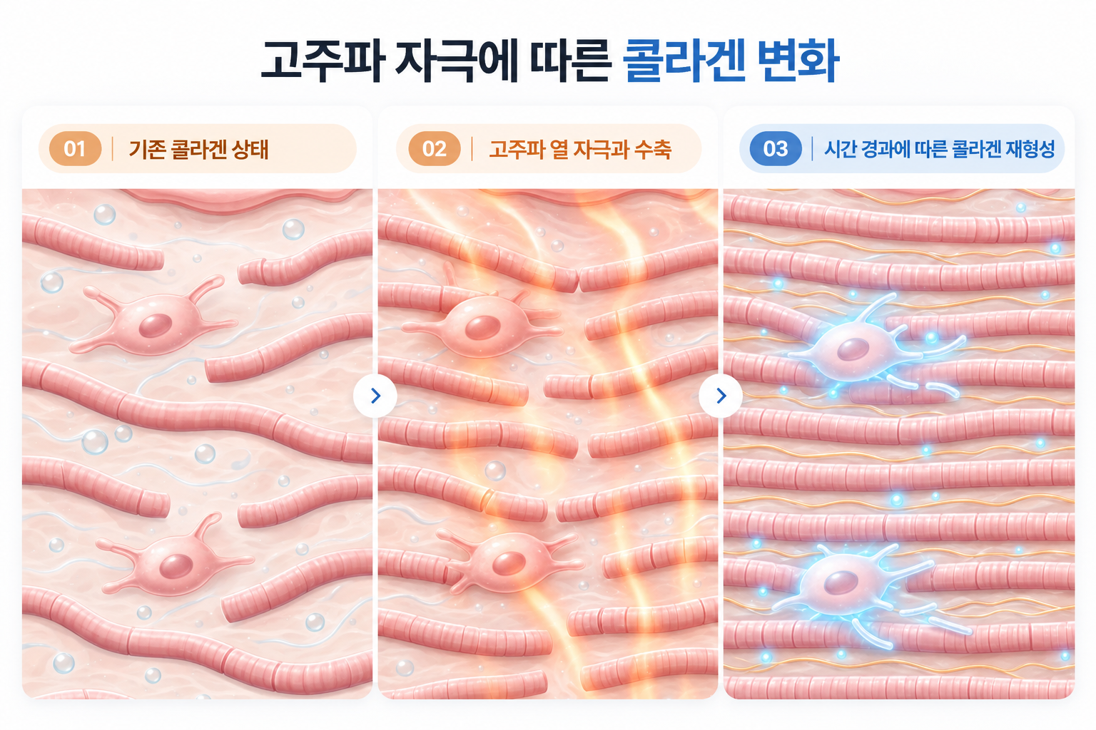 존 콜라겐 상태부터 고주파 열 자극에 따른 수축과 시간 경과에 따른 콜라겐 재형성 과정