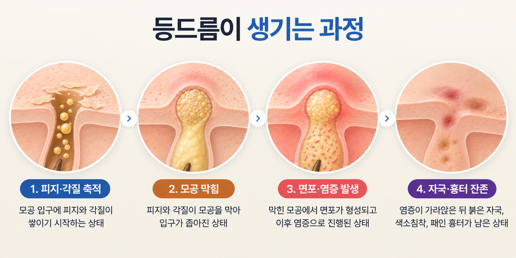 등드름 피지 각질 축적부터 모공 막힘 염증 자국 흉터까지의 발생 과정