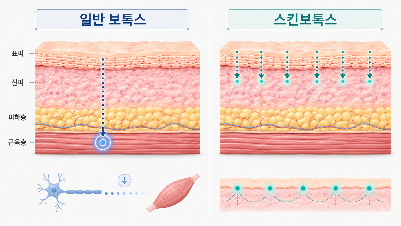 일반 보톡스 근육층과 스킨보톡스 얕은 피부층의 주입 깊이 비교