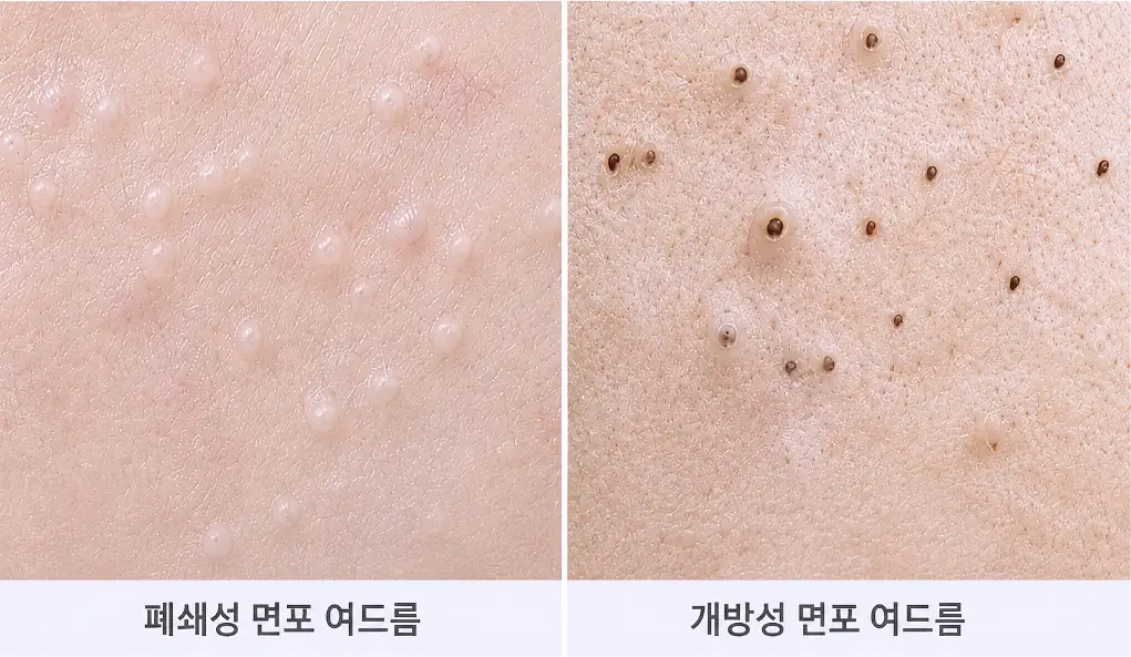 광명여드름치료 전 확인하는 폐쇄성 면포와 개방성 면포의 형태