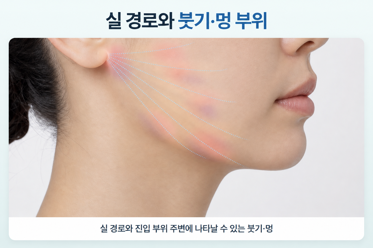 실리프팅 후 귀 앞쪽에서 볼과 턱선 방향으로 표시된 실 경로와 진입 부위 주변에 붓기·멍이 나타날 수 있는 위치