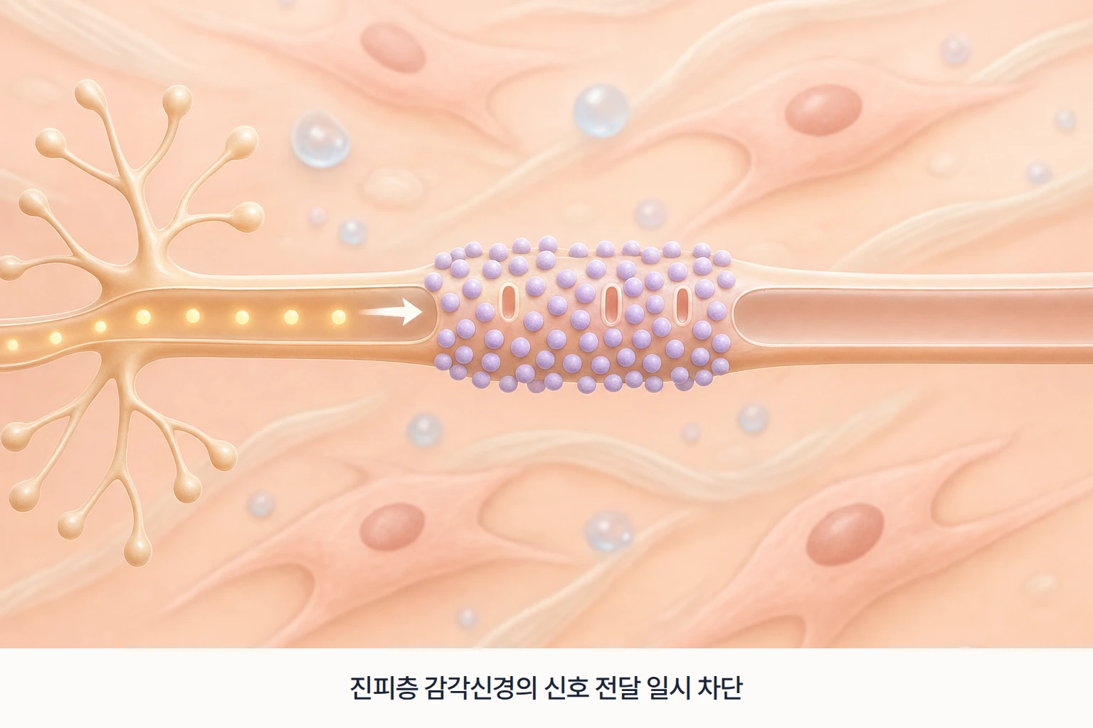 리도카인 입자가 진피층 감각신경 말단의 통증 신호 전달을 일시적으로 막는 원리를 확대한 모식도