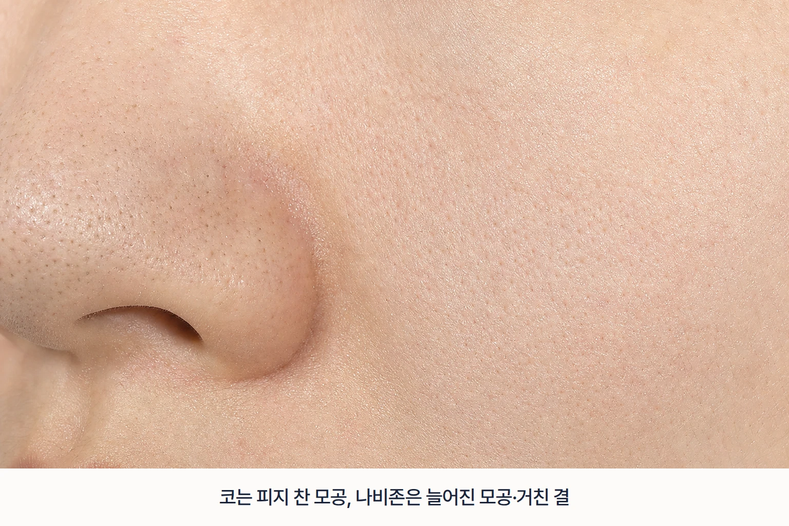 코 블랙헤드와 피지로 도드라진 모공, 나비존의 넓어진 모공과 불균일한 피부결