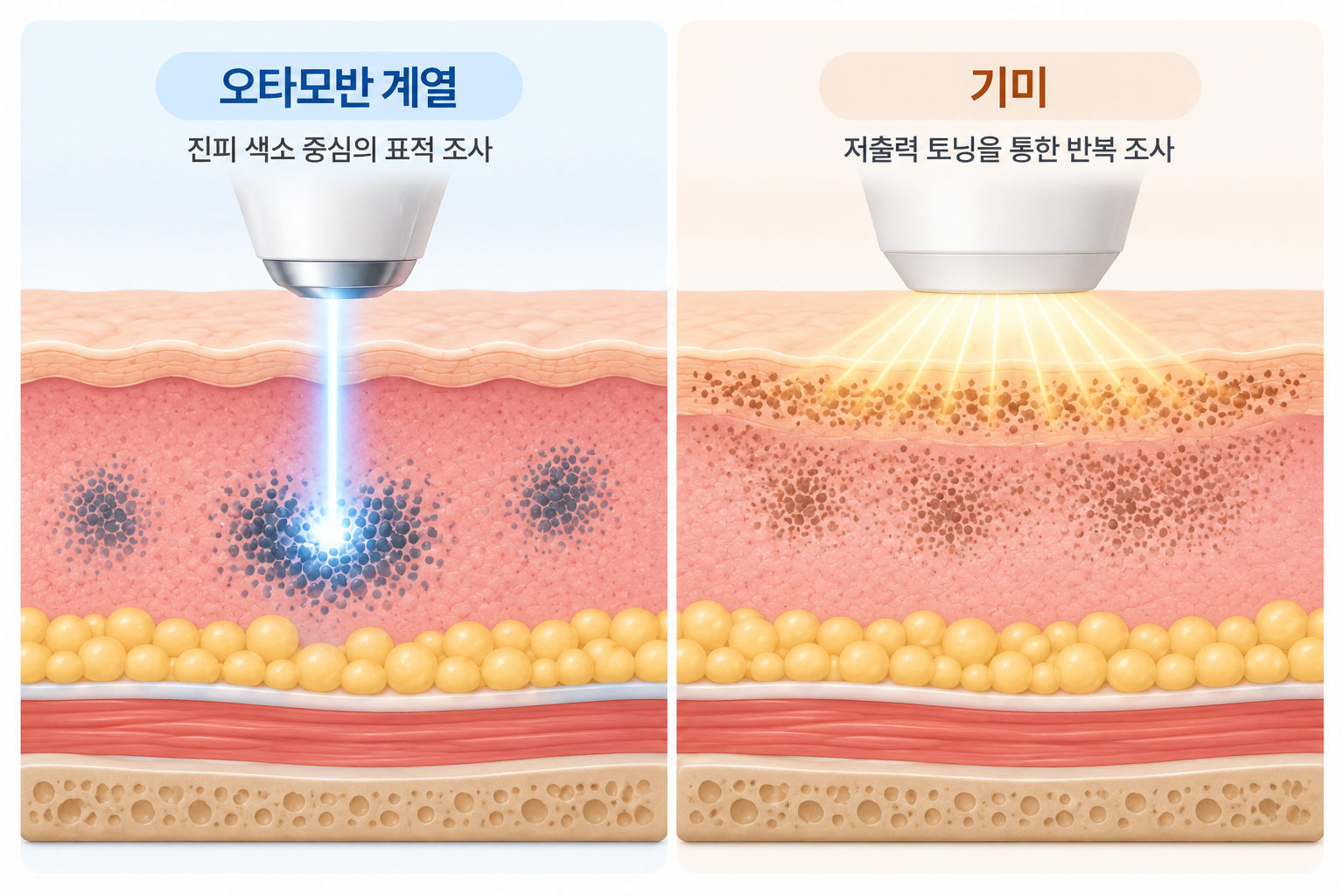 오타모반 진피 색소 표적 조사와 기미 저출력 토닝 비교