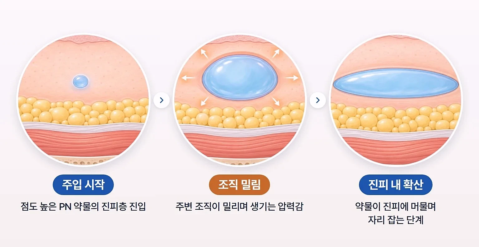 점도 높은 PN 약물이 진피층에 들어가 주변 조직을 밀며 퍼지는 과정을 단계별로 그린 피부 단면도