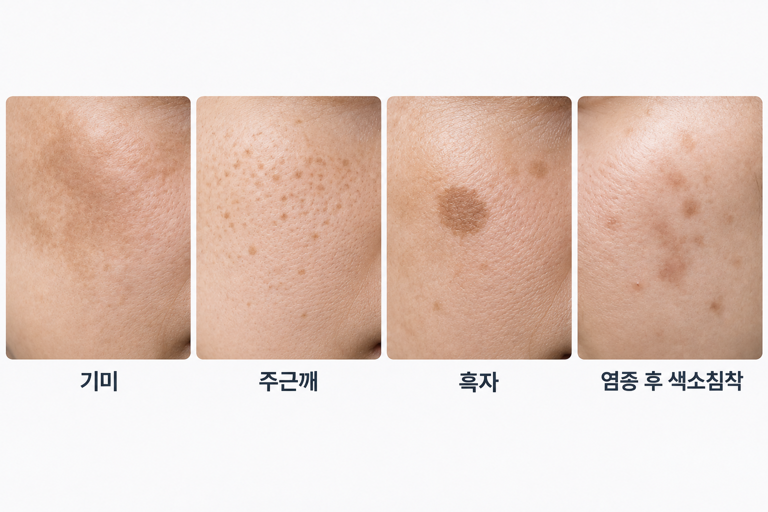 기미 주근깨 흑자 염증 후 색소침착의 피부 형태