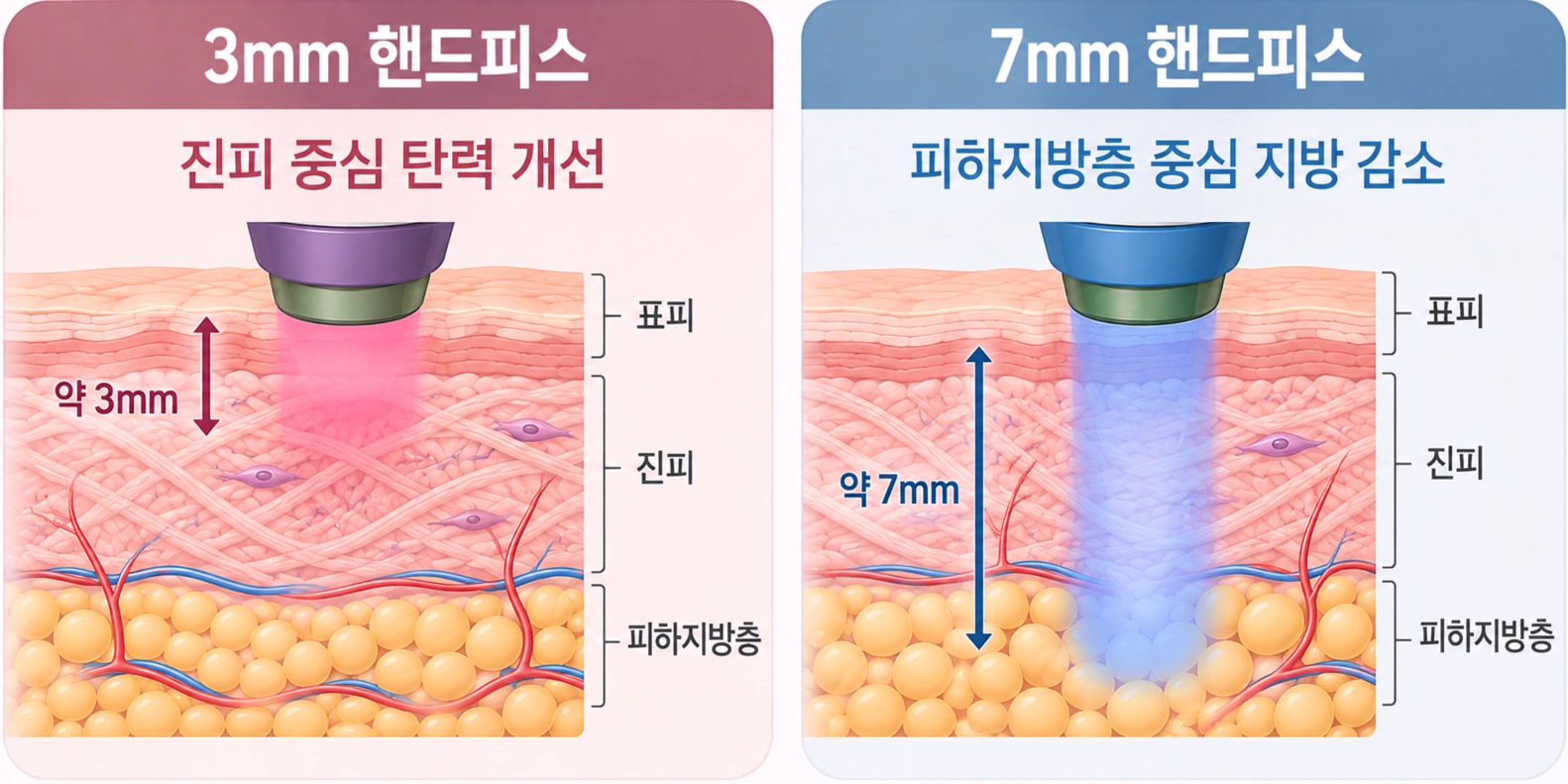 온다 레이저 3mm와 7mm 핸드피스의 에너지 도달 깊이와 적용 부위를 비교한 피부 단면도
