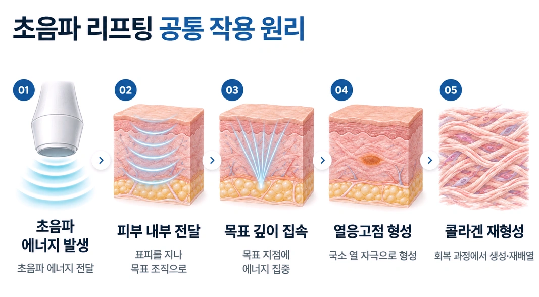초음파 리프팅 에너지가 피부 속 목표 깊이에 집중되어 열응고점을 형성하고 콜라겐 재형성을 유도하는 원리