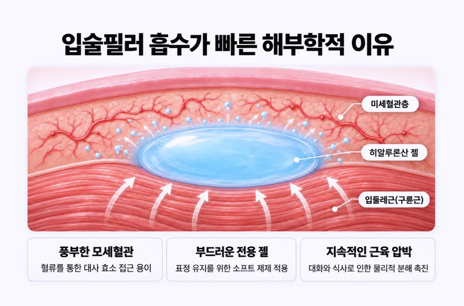 입술 점막 아래 미세혈관층과 입둘레근(구륜근) 사이 히알루론산 젤의 위치 및 근육 압박과 혈류로 인한 입술필러 흡수 과정을 설명한 해부학 단면 모식도
