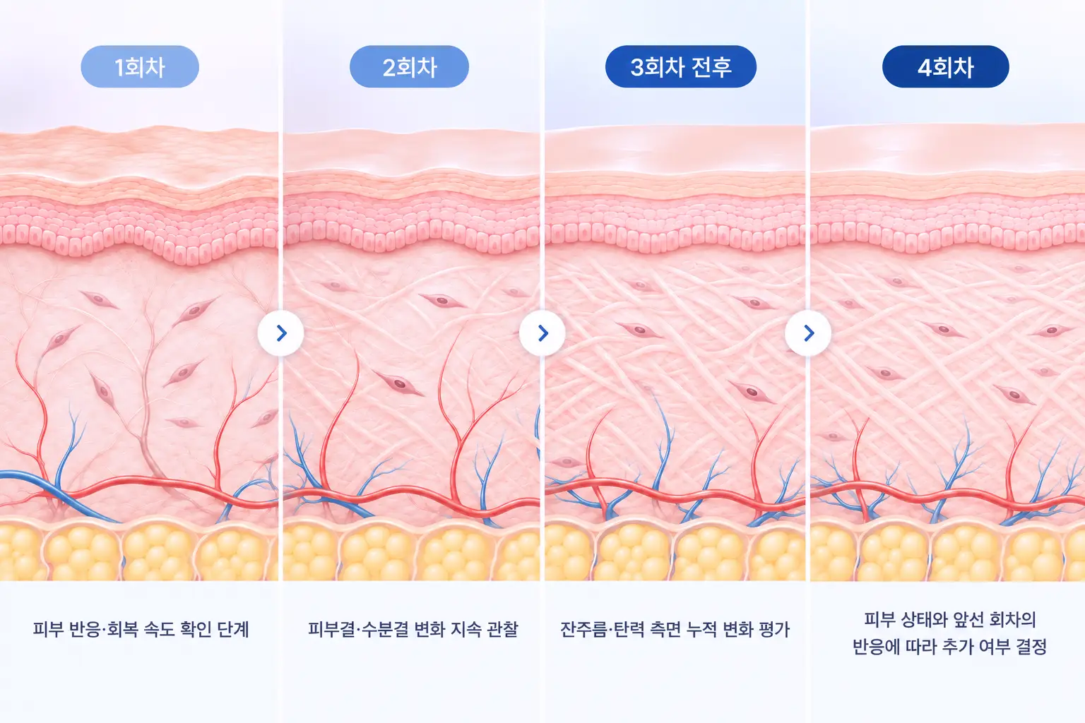 회차가 누적될수록 진피 콜라겐 섬유 밀도가 달라지는 변화를 단계별로 비교한 피부 단면도