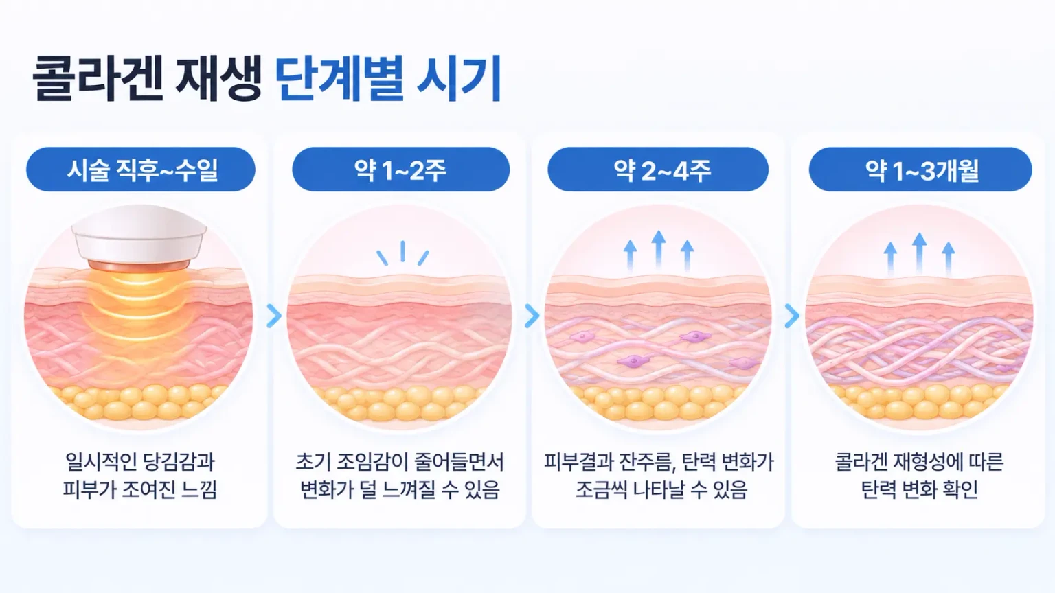 회복 반응기, 콜라겐 생성기, 재배열·성숙기로 이어지는 콜라겐 재생 시기를 정리한 타임라인 이미지