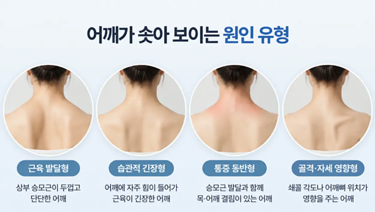 어깨가 솟아 보이는 원인을 근육 발달형, 습관적 긴장형, 통증 동반형, 골격·자세 영향형으로 구분한 승모근 보톡스 시술 적합성 비교 인포그래픽