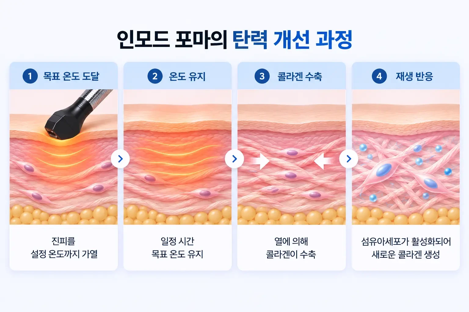 느슨한 콜라겐 섬유가 고주파 열로 수축하고 섬유아세포가 새 콜라겐을 만드는 과정의 단계별 개념도