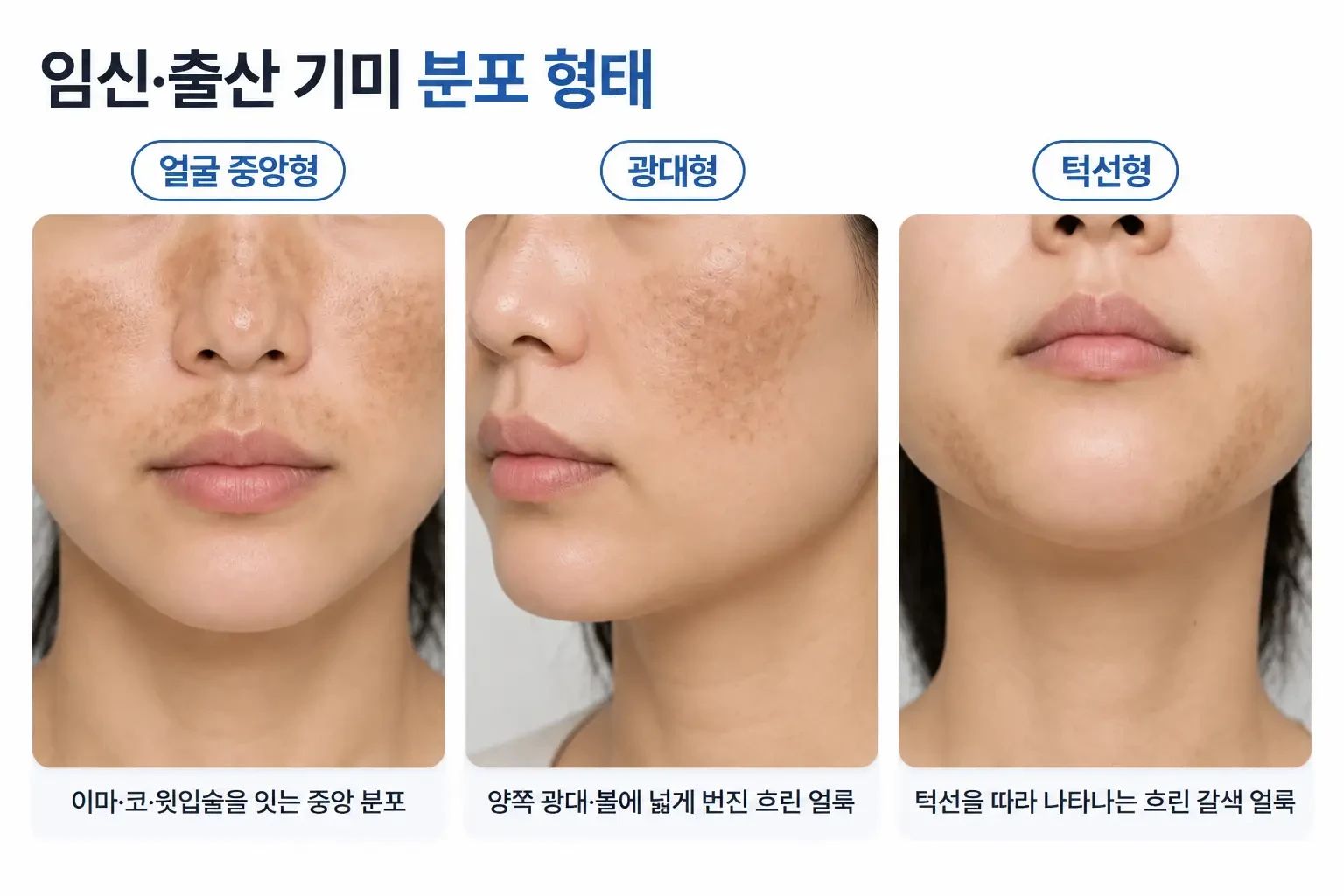 얼굴 중앙형, 광대형, 턱선형 기미의 좌우 대칭 분포를 같은 각도로 비교한 하관 부위 사진
