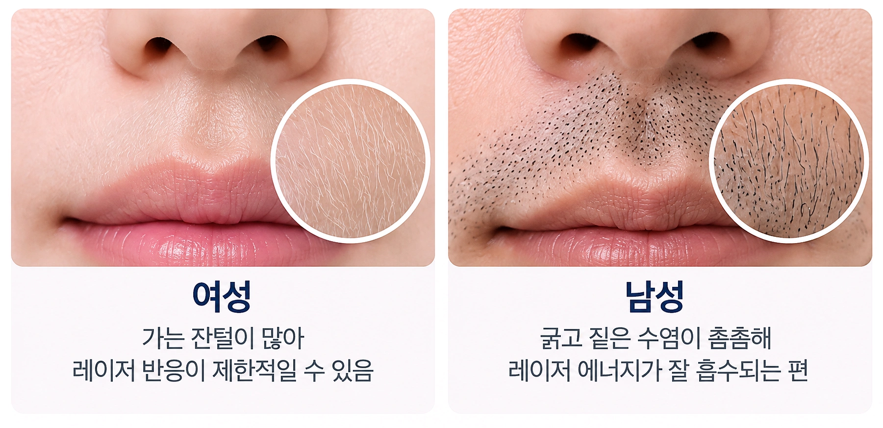 여성,남성별 털의 굵기와 색에 따라 달라지는 레이저 반응