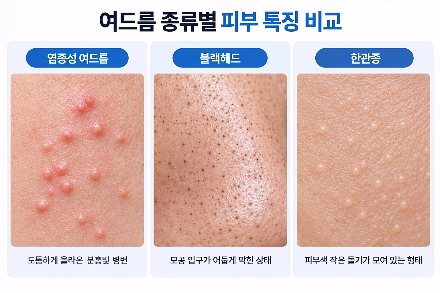 염증성 여드름, 블랙헤드, 한관종의 표면 외형을 같은 배율로 비교한 피부 확대 사진
