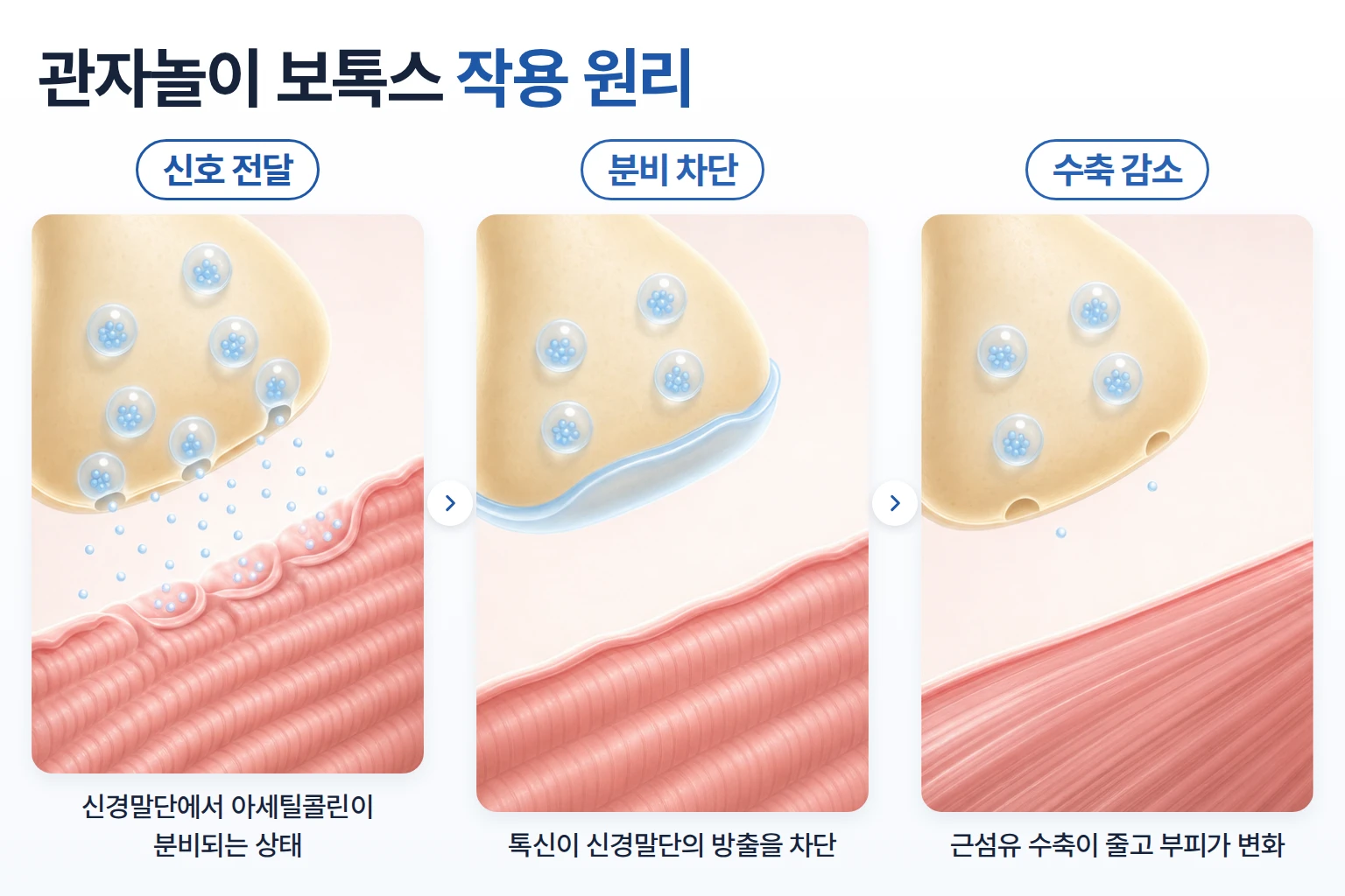 관자놀이 보톡스의 신경말단 아세틸콜린 분비 차단과 근섬유 수축 감소를 단계별로 나타낸 개념도