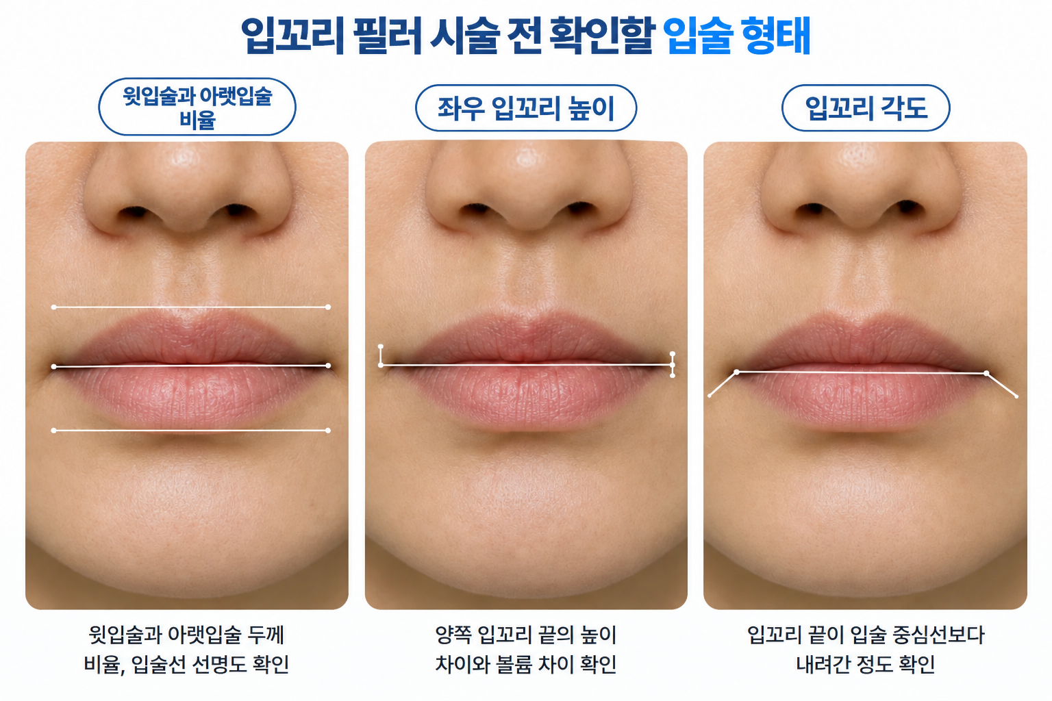 입꼬리 필러 전후 차이에 영향을 주는 윗입술과 아랫입술 두께 비율, 좌우 입꼬리 높이, 입술 끝이 아래로 기울어진 각도 분석