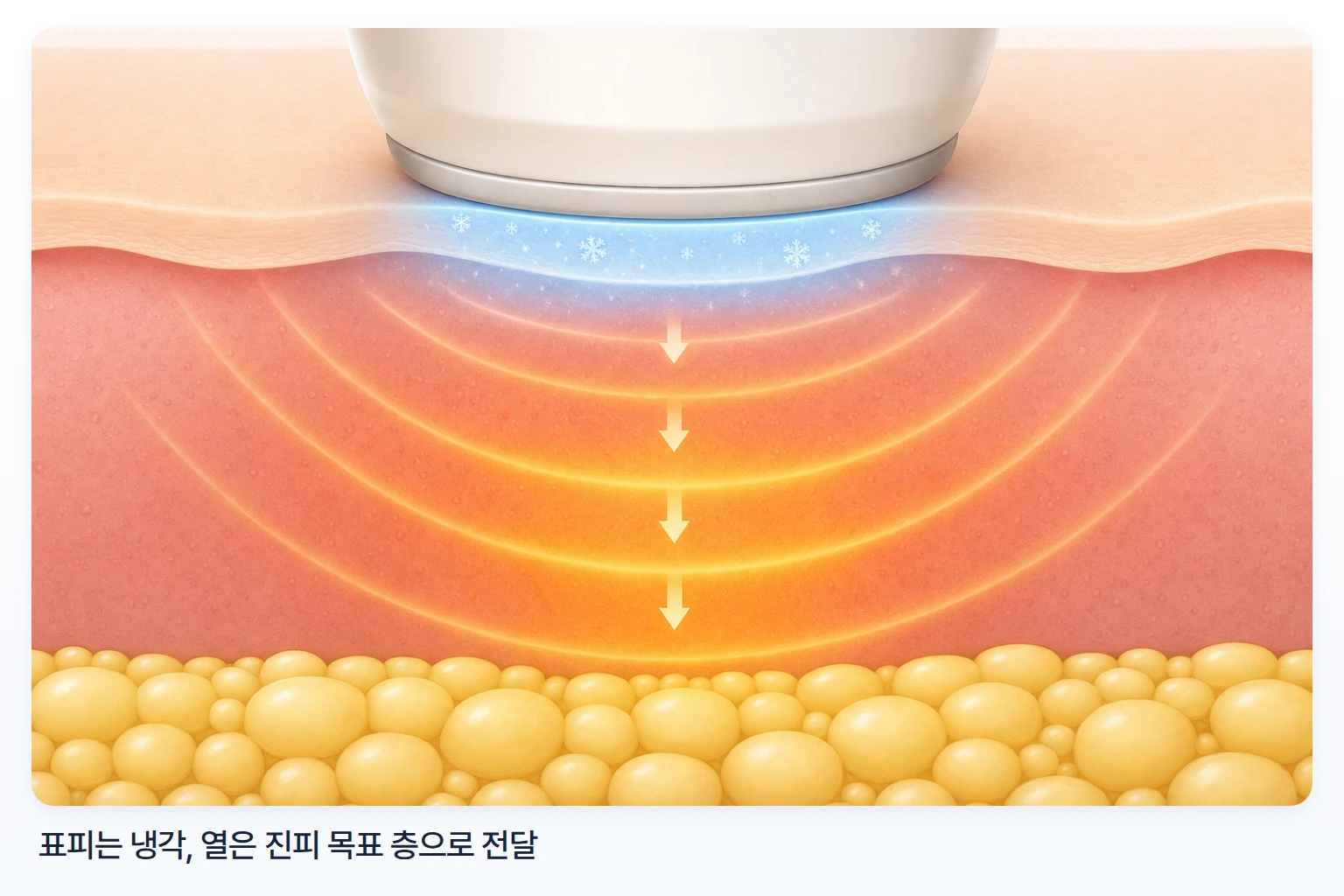 덴서티 팁이 표피를 냉각하며 고주파 열을 진피 쪽으로 전달하는 모습의 에너지 전달 일러스트