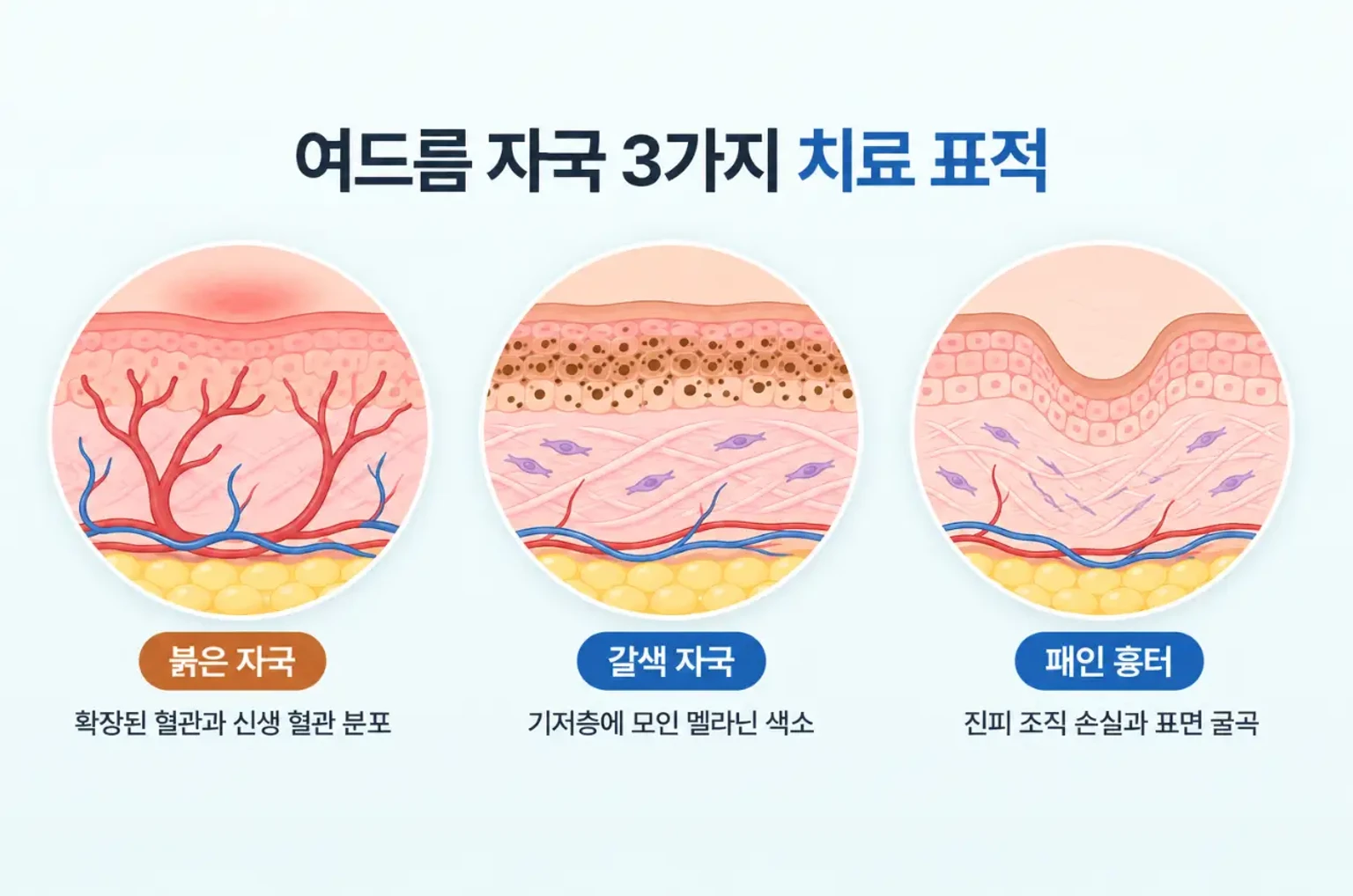 붉은 자국의 혈관, 갈색 멜라닌, 패인 흉터를 같은 배율로 비교한 피부 단면 일러스트