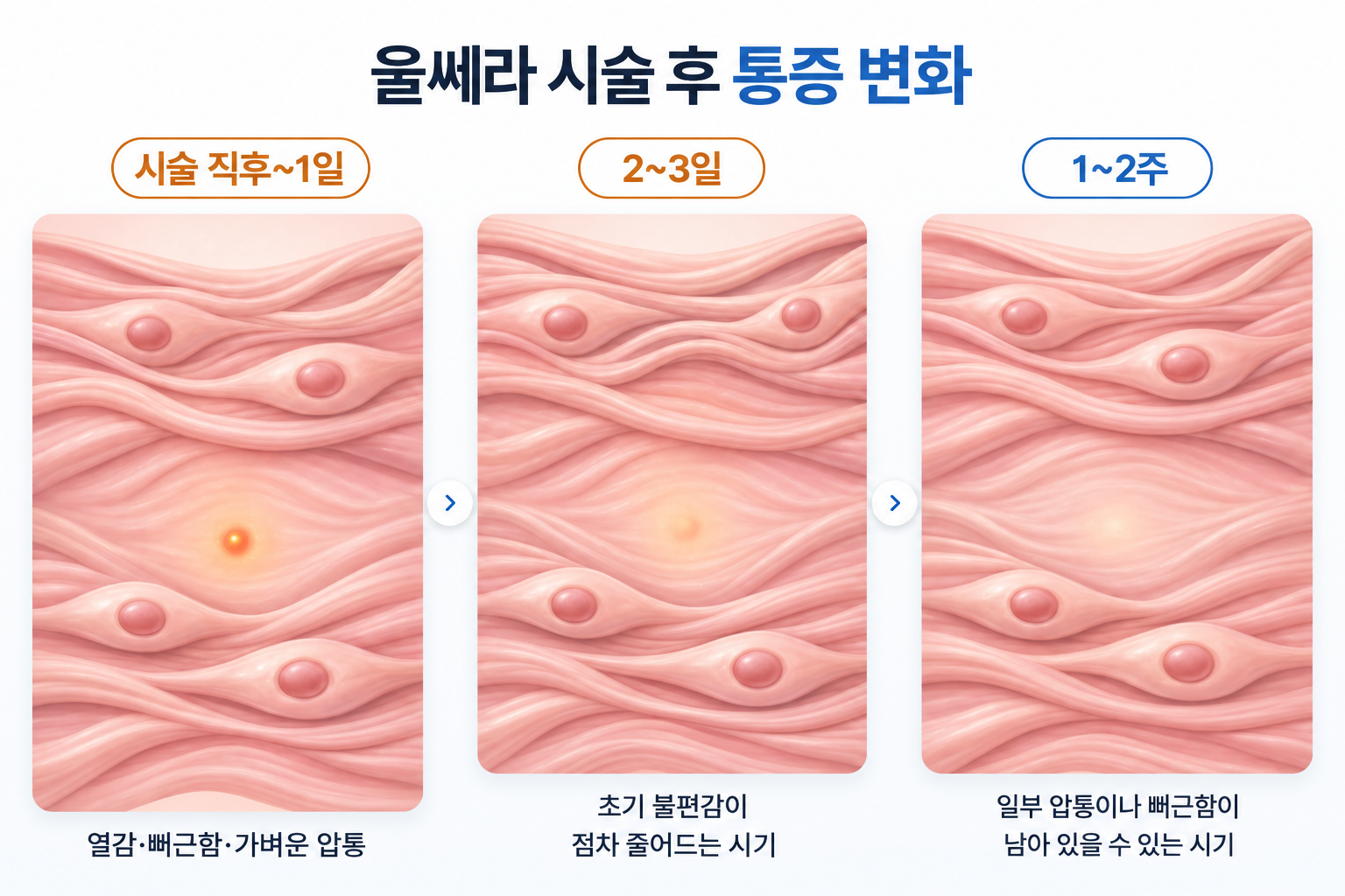 울쎄라 시술 후 통증 지속기간에 따른 직후 열감과 뻐근함, 2~3일 초기 불편감 감소, 1~2주 압통 지속 가능성