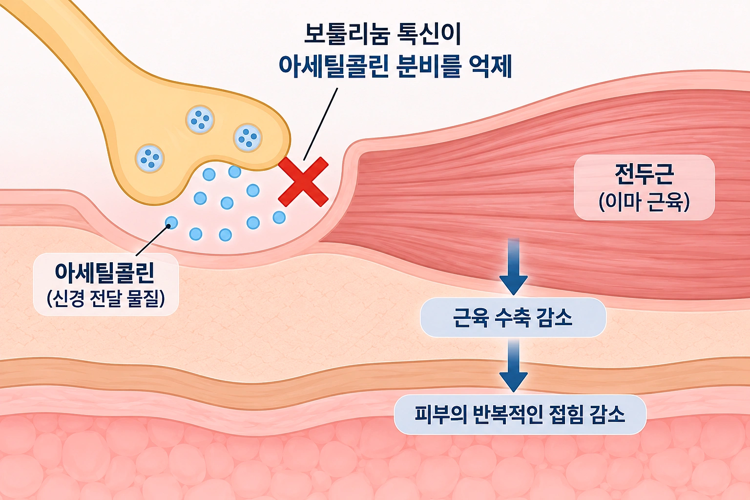 보툴리눔 톡신이 아세틸콜린 분비를 억제해 전두근의 반복적인 수축을 줄이는 이마주름 보톡스 작용 원리 모식도