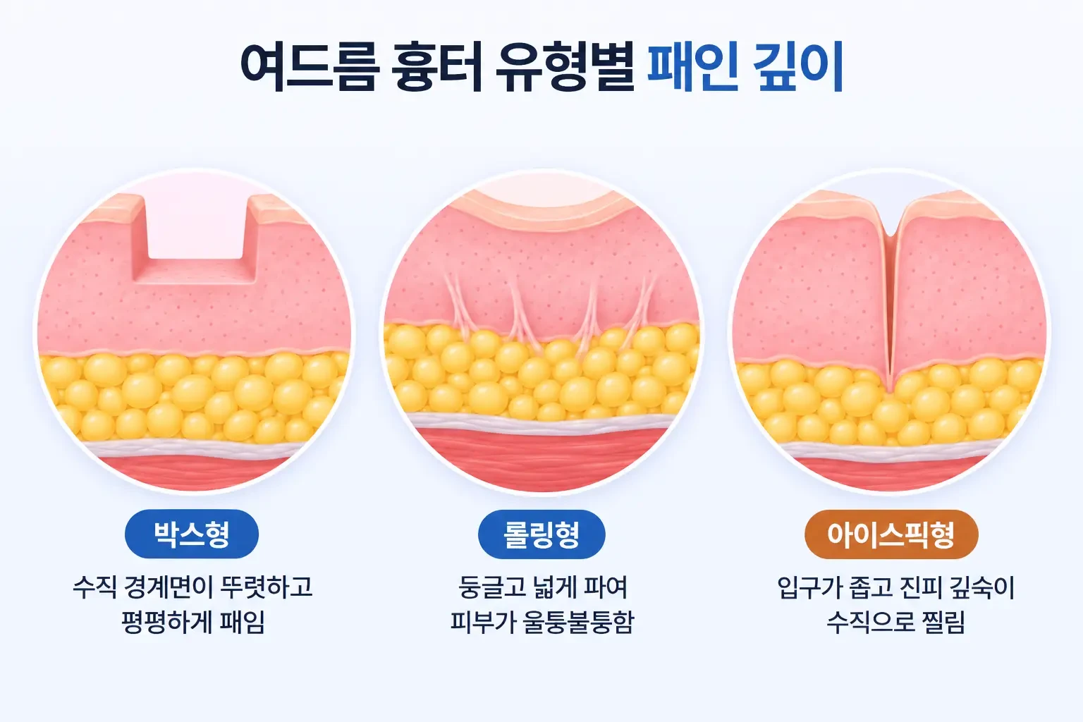 박스형, 롤링형, 아이스픽형 여드름 흉터의 패인 깊이와 모양을 동일 배율로 비교한 피부 단면 모식도