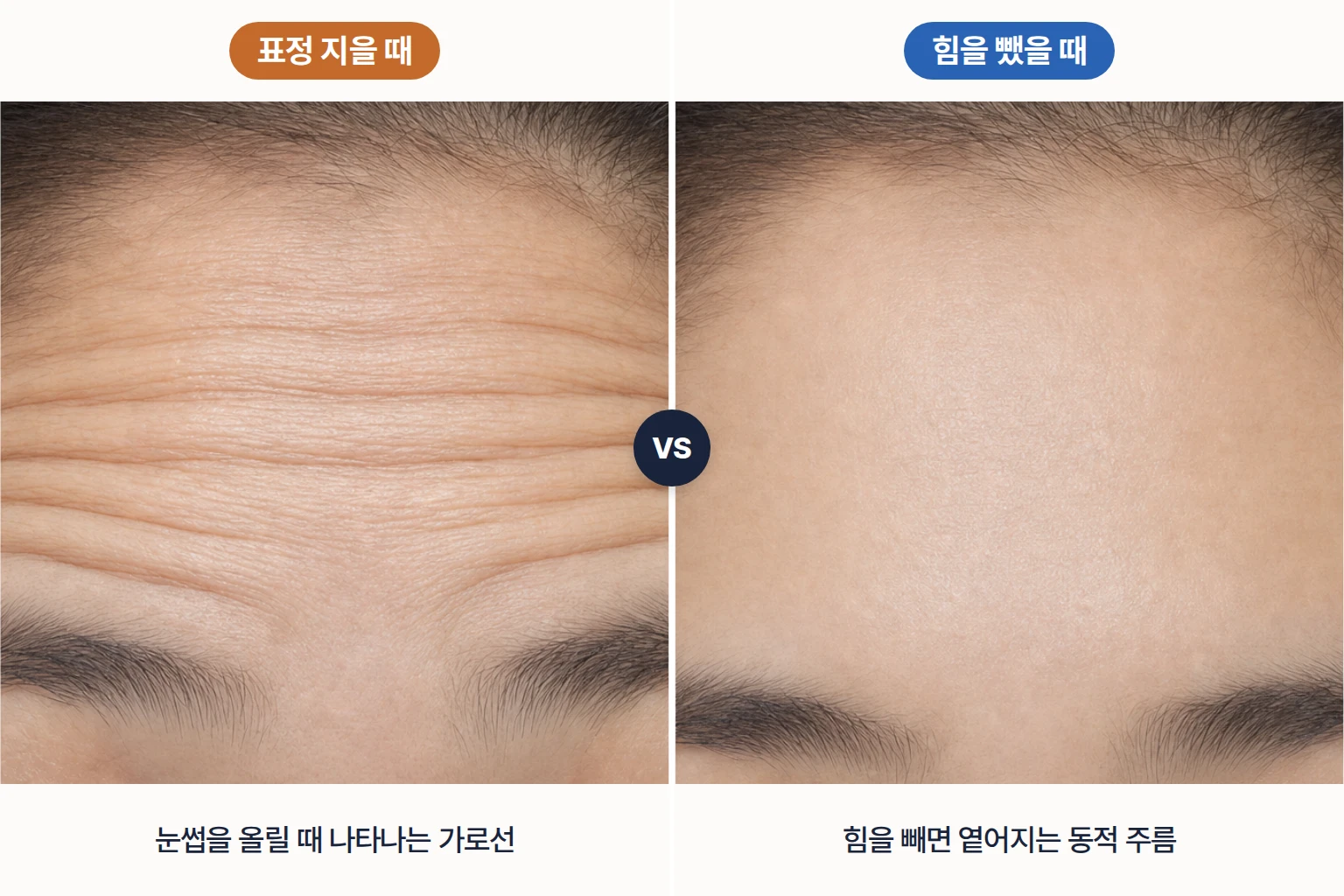 표정을 지을 때와 힘을 뺐을 때 나타나는 이마 가로 주름 차이