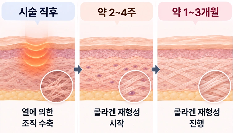 브이로 어드밴스 시술 직후부터 2~4주, 1~3개월까지 콜라겐 재형성이 진행되는 과정을 나타낸 단계별 피부 단면도
