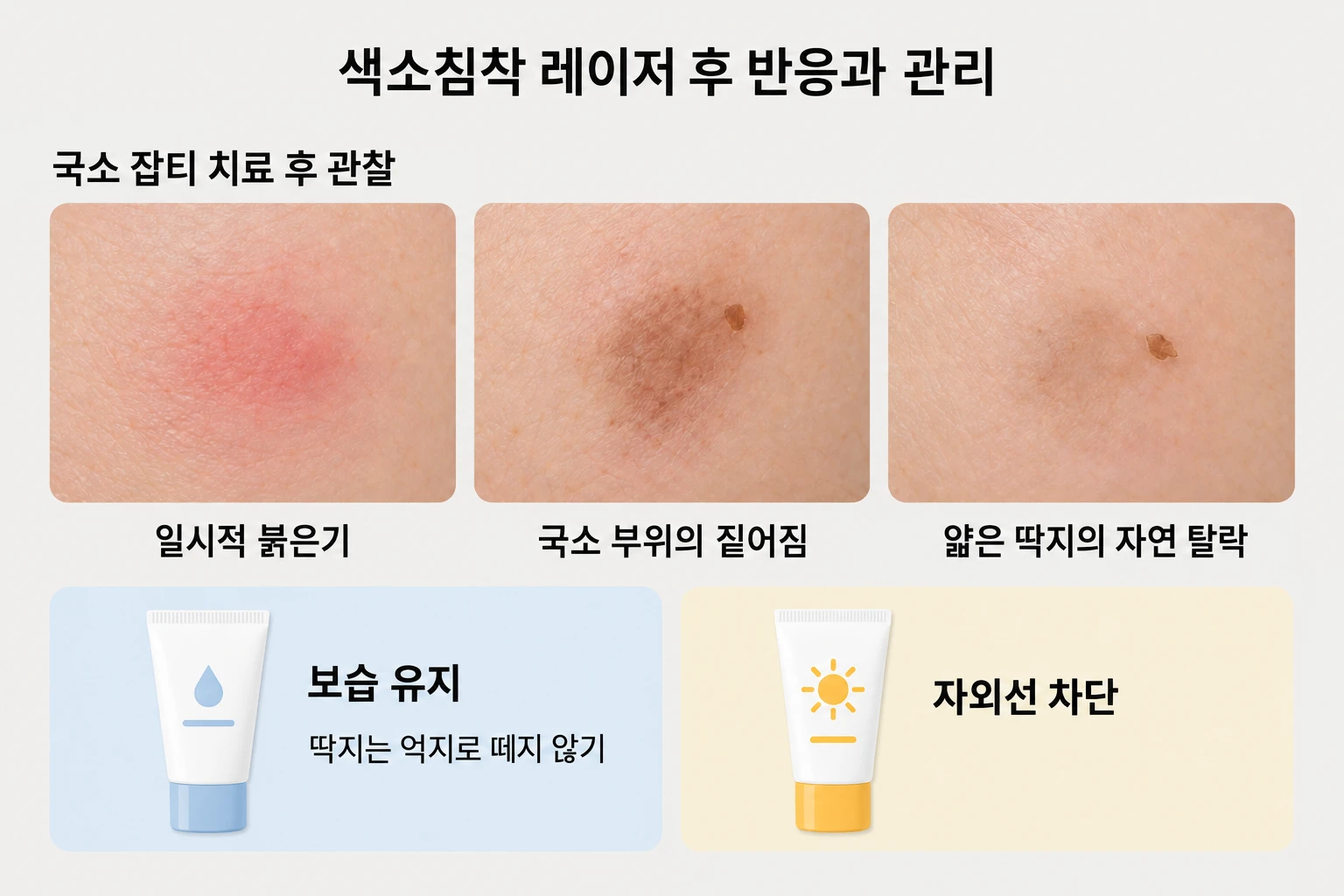 국소 레이저 후 붉은기와 얇은 딱지 관찰 및 보습·자외선 차단 관리