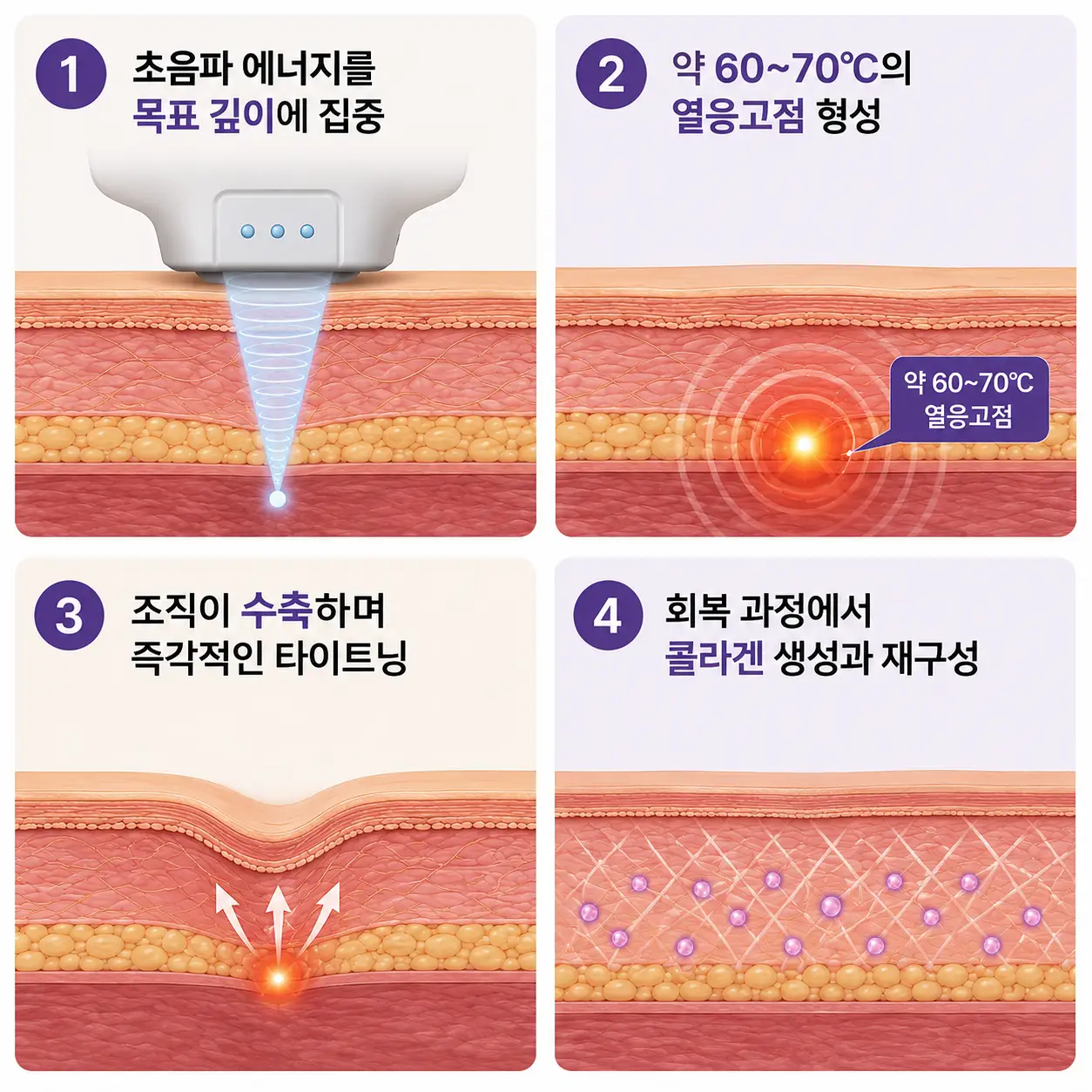 대구 피부과_ 집속초음파 열응고점 형성과 콜라겐 재생을 통한 울쎄라 작용 원리