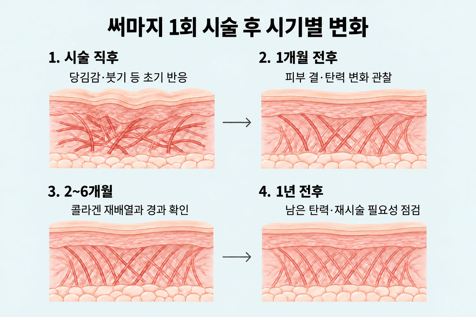 써마지 시술 직후부터 1년 전후까지의 피부 반응과 탄력 점검 흐름