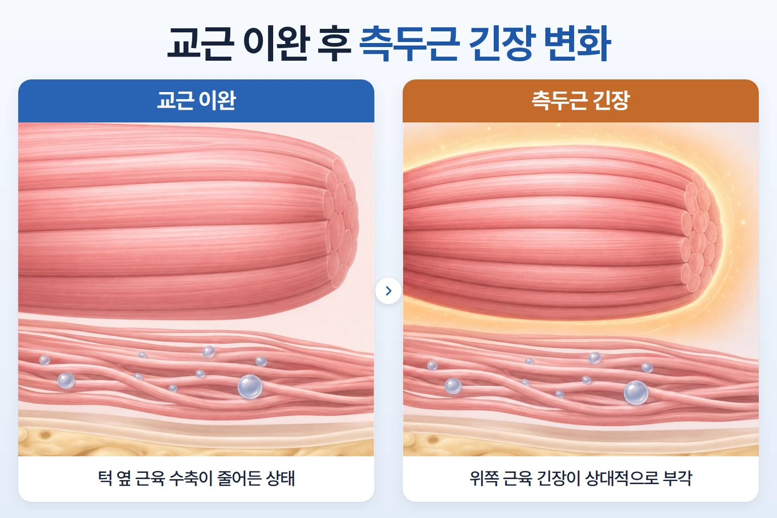 교근 섬유 이완과 측두근 긴장이 상대적으로 부각되는 저작근 균형 변화 비교 일러스트