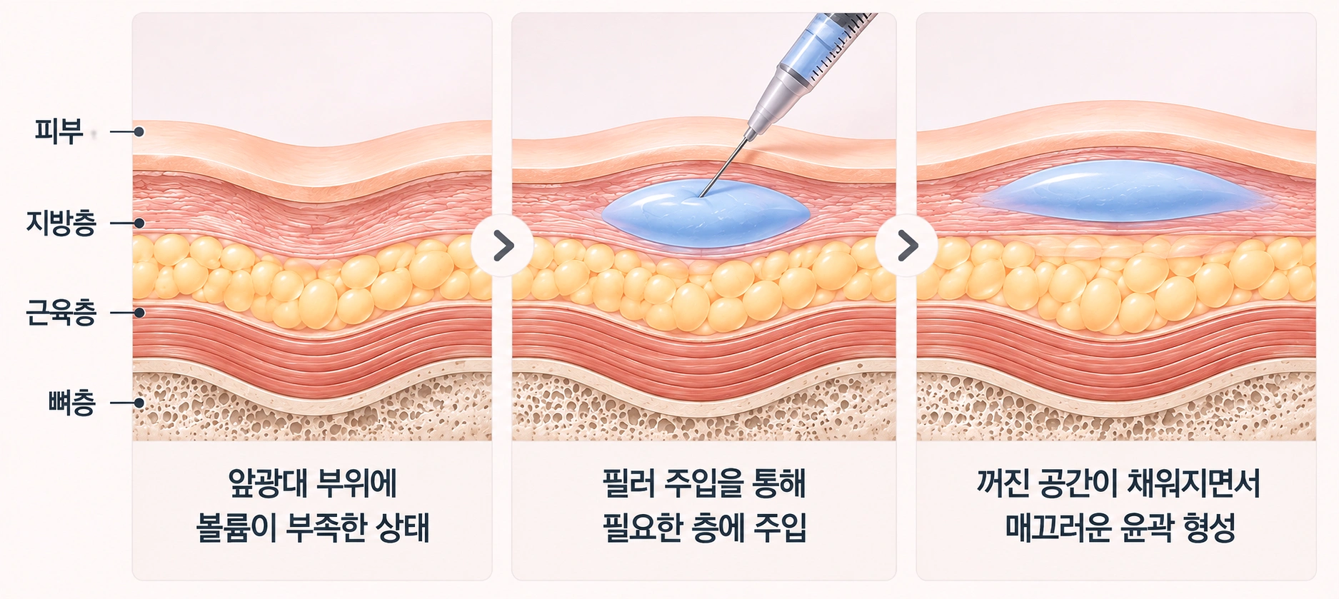 꺼진 앞광대에 필러를 주입해 부족한 볼륨을 보완하는 원리