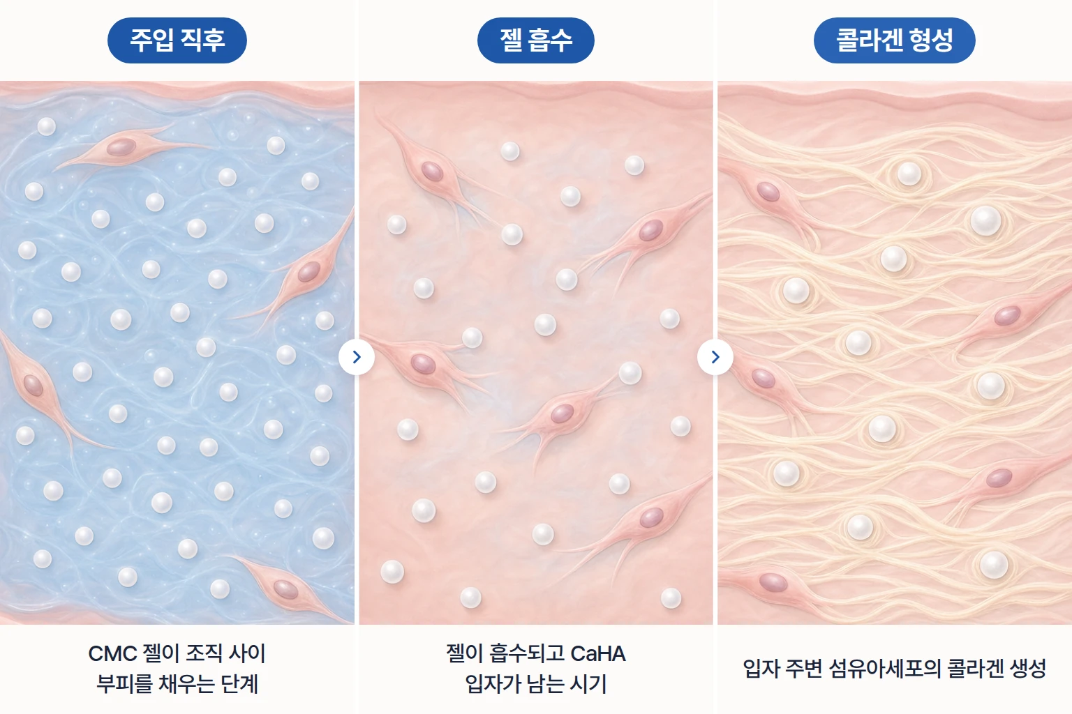 CMC 젤 부피 형성, 젤 흡수, CaHA 입자 주변 콜라겐 생성을 단계별로 나타낸 래디어스 개념도