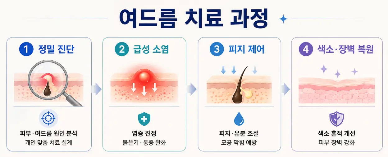 정밀 진단부터 급성 소염과 피지 제어 및 색소 장벽 복원으로 이어지는 유앤아이의원 대전점 여드름 치료 과정