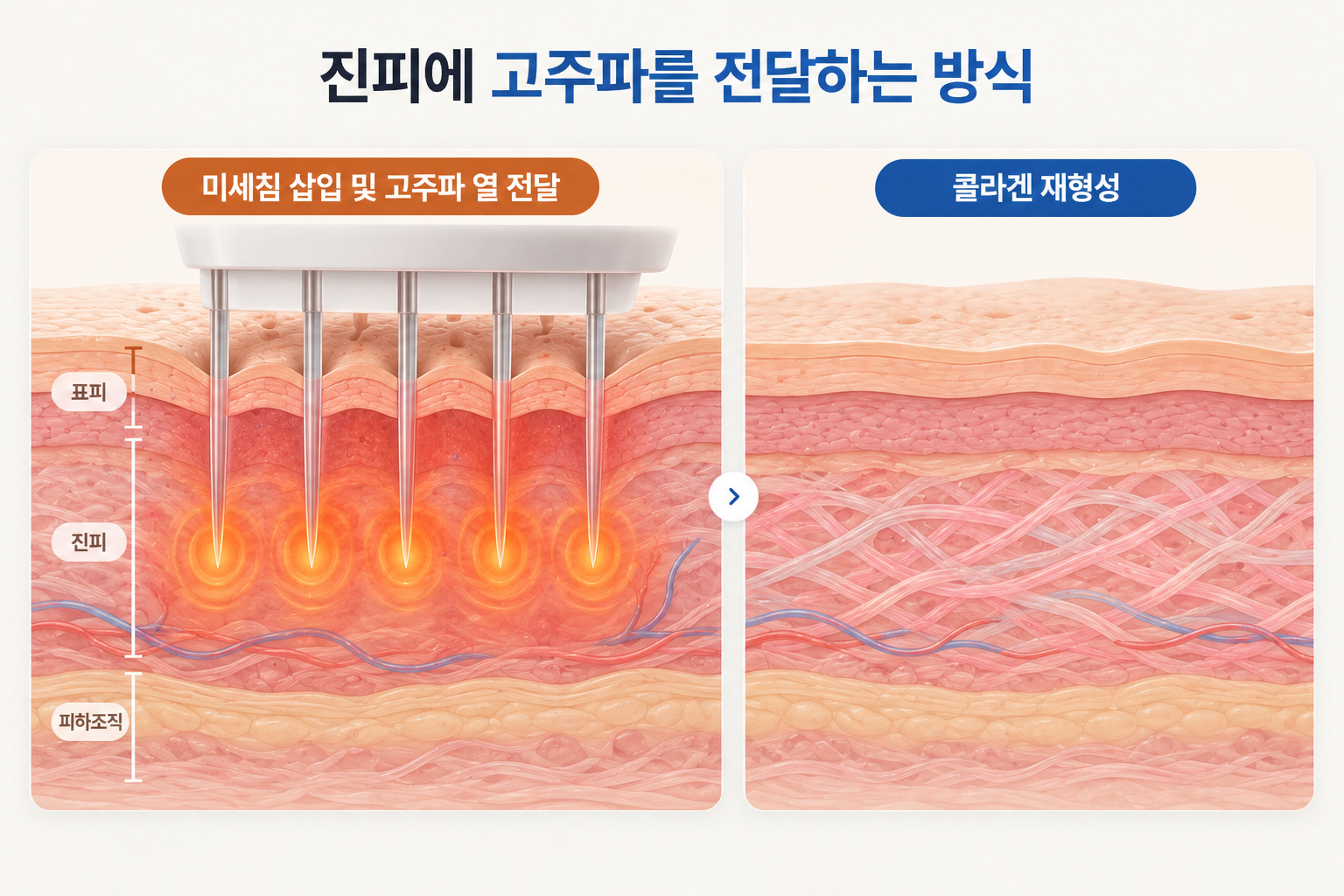등드름 흉터 치료 시 미세침 고주파의 진피 에너지 전달과 콜라겐 재형성