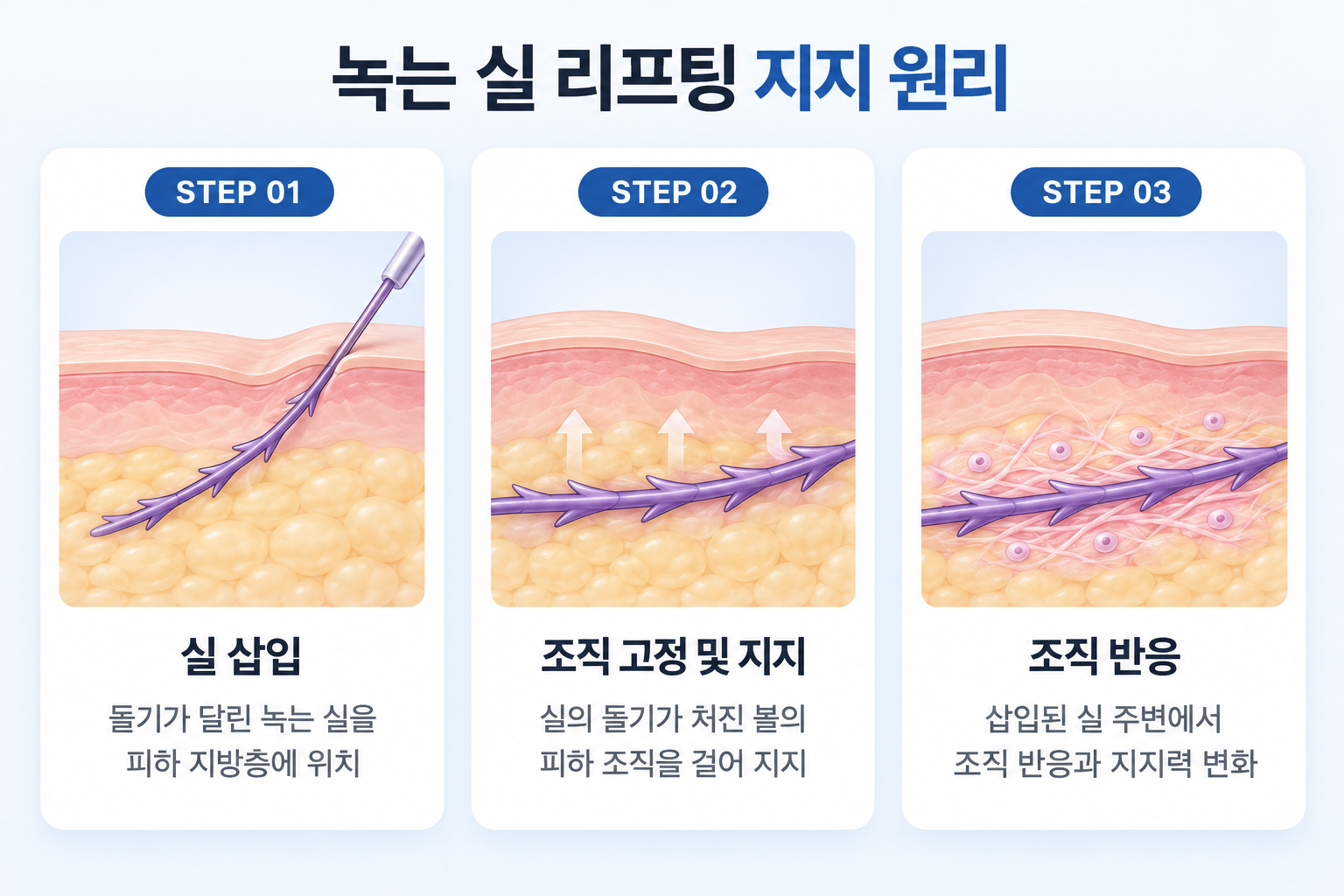 녹는 실 삽입과 돌기를 이용한 볼 조직 지지, 실 주변 조직 반응의 3단계 과정