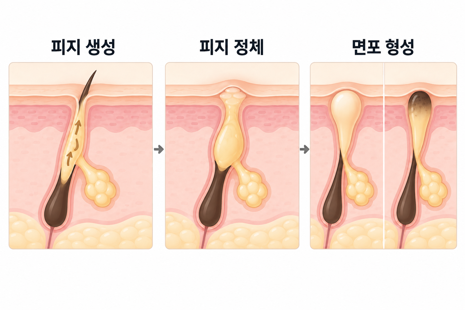모공 속 피지가 정체되어 화이트헤드와 블랙헤드가 형성되는 과정