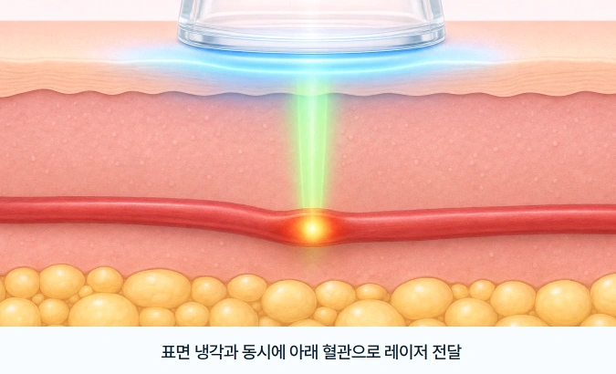 엑셀브이 레이저의 피부 표면 냉각과 혈관으로의 레이저 에너지 전달 과정을 나타낸 피부 단면도