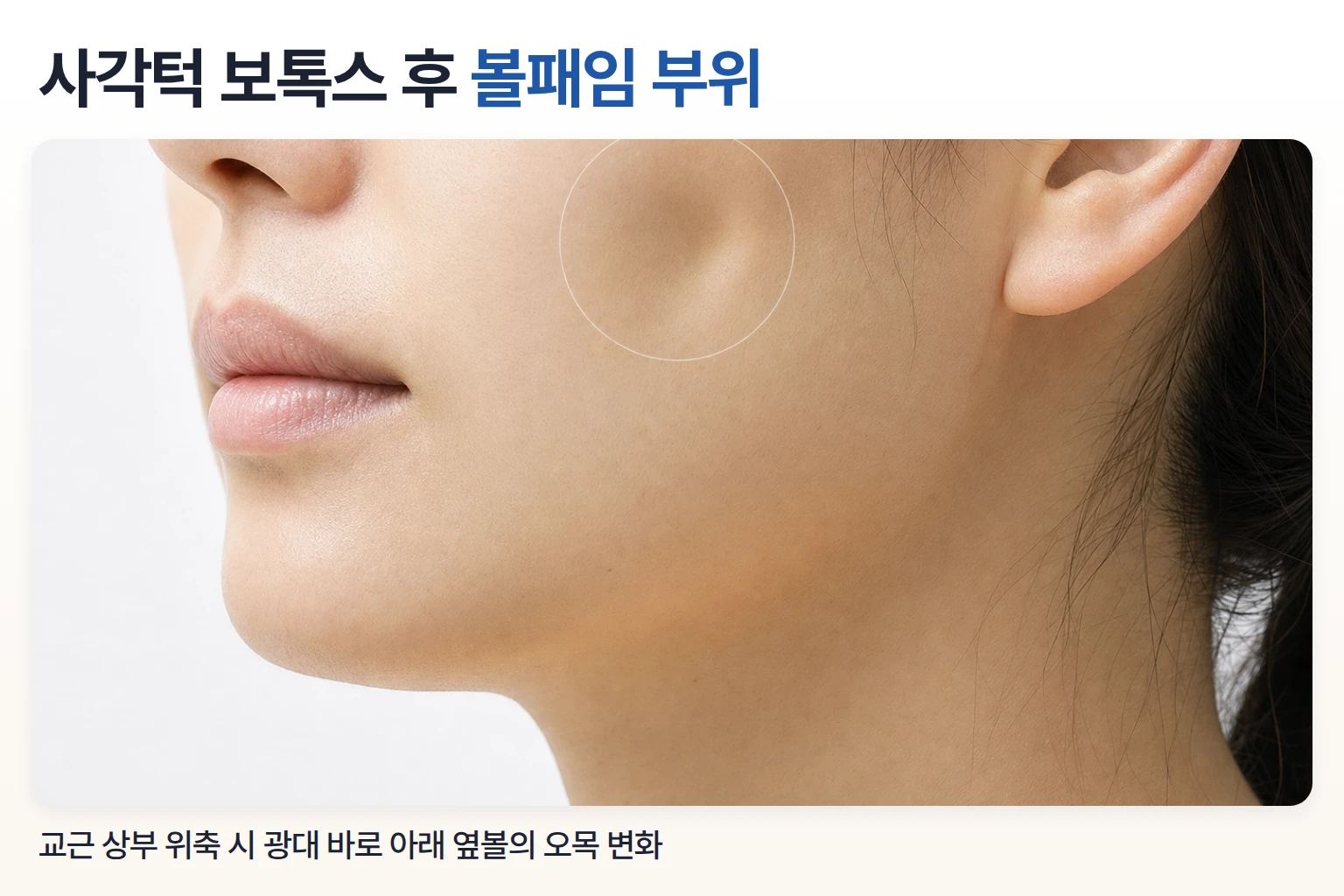 교근 위쪽 부피가 줄어 광대 아래 옆볼이 오목해 보이는 부위를 표시한 얼굴 하관 측면 크롭 사진