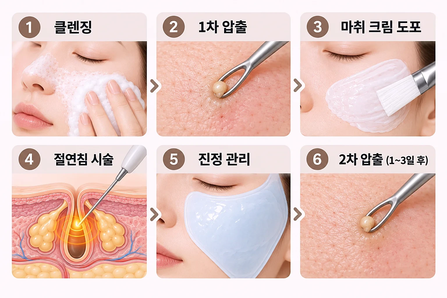 마취 크림 도포, 깊이 설정, 절연침 시술, 진정 관리 순서를 정리한 시술 단계 흐름