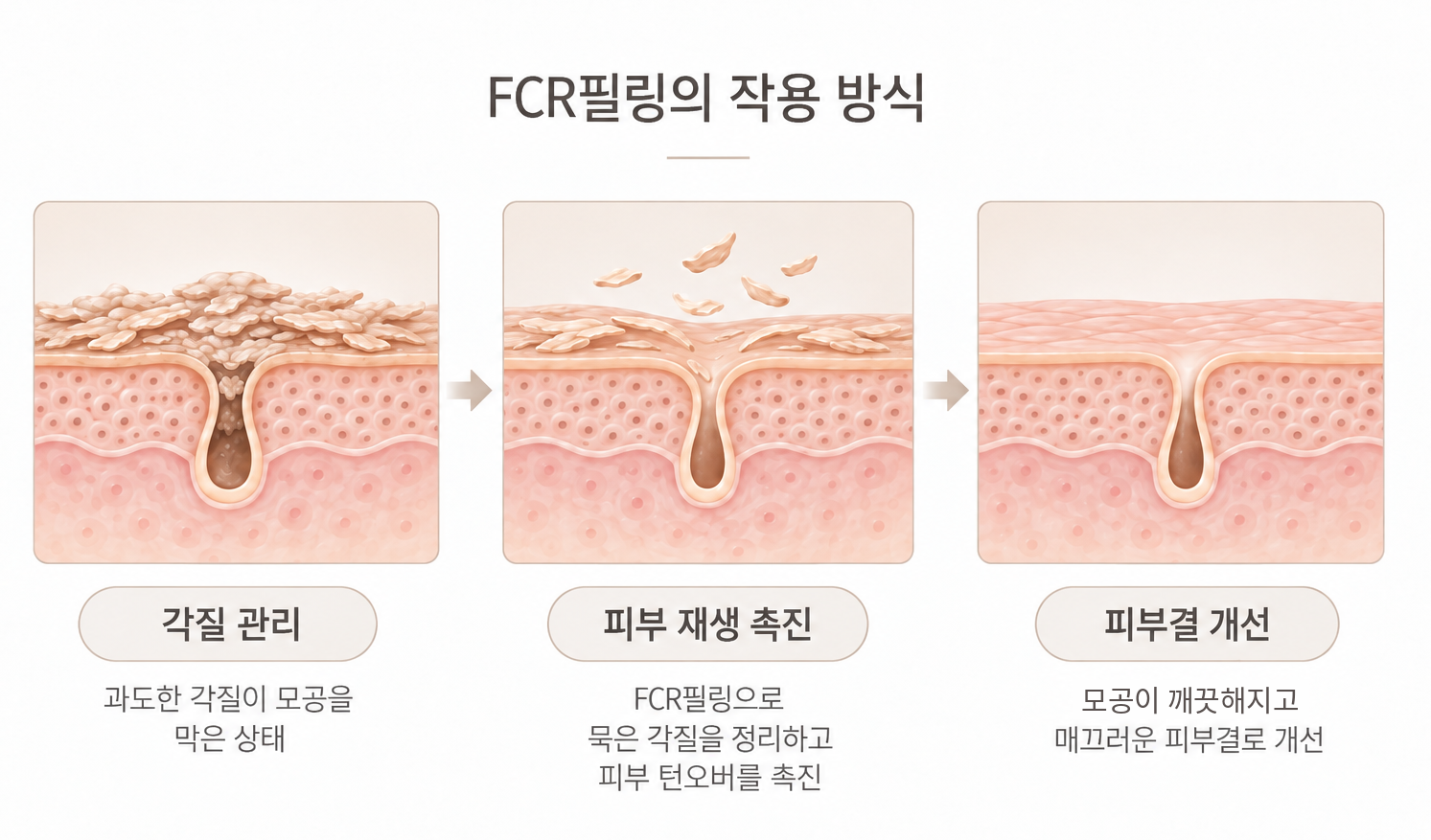쌓인 각질을 정돈하고 피부 재생을 거쳐 피부결을 개선하는 FCR필링 작용 과정