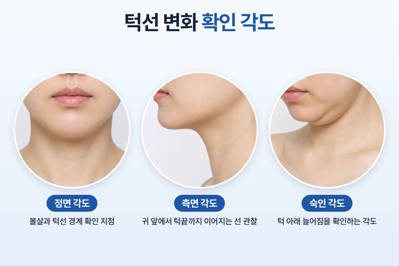 정면, 측면, 숙인 각도에서 턱선과 하관 윤곽 변화를 각도별로 확인하는 비교 사진